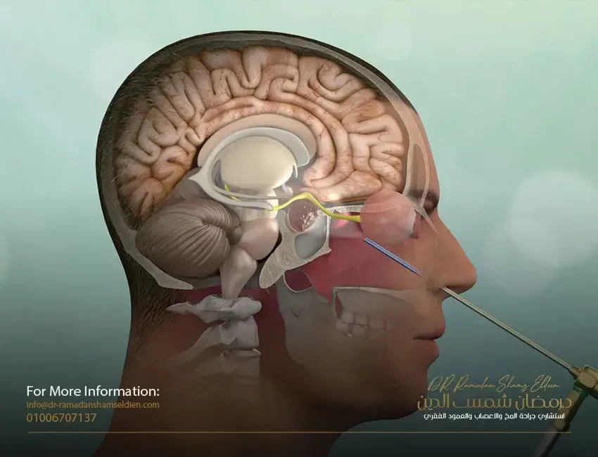 تعليمات ونصائح بعد عمليات المخ - الجمجمة