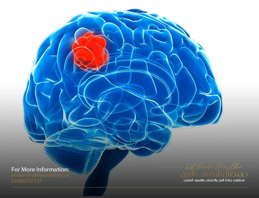 ما نسبة الشفاء من ورم الدماغ الحميد؟