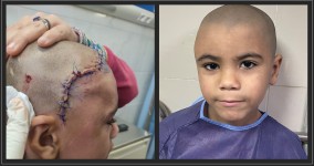 ورم بعظام الجمجمة الجبهية ضاغط علي المخ والعين اليمني بطفل 7 سنوات