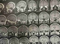 cpa  ورم بالحجرة الخلفية بالمخ مؤثر علي عصب الاتزان وعضلات الوجه