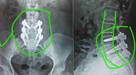 انزلاق غضروفي مع تزحزح فقاري