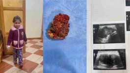 ورم بغلاف عصب عرق النسا الايمن بطفلة خمس سنوات ونصف