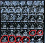 ورم سحائي بالنخاع الشوكي مقابل الفقرة الصدرية الرابعة