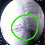 استئصال غضروف قطني بالمنظار