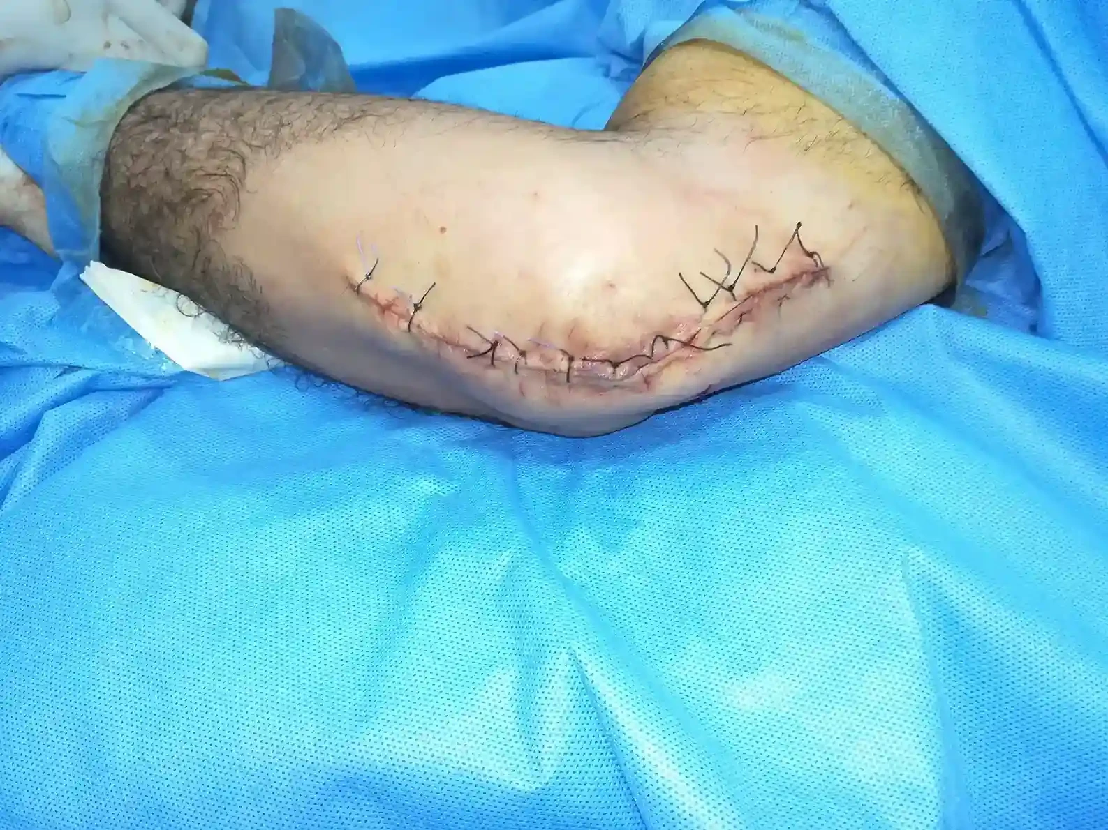 رفع نتوء عظمي من العصب الزندي الايمن عند المرفق مع نقل للعصب بتجويف عضلي