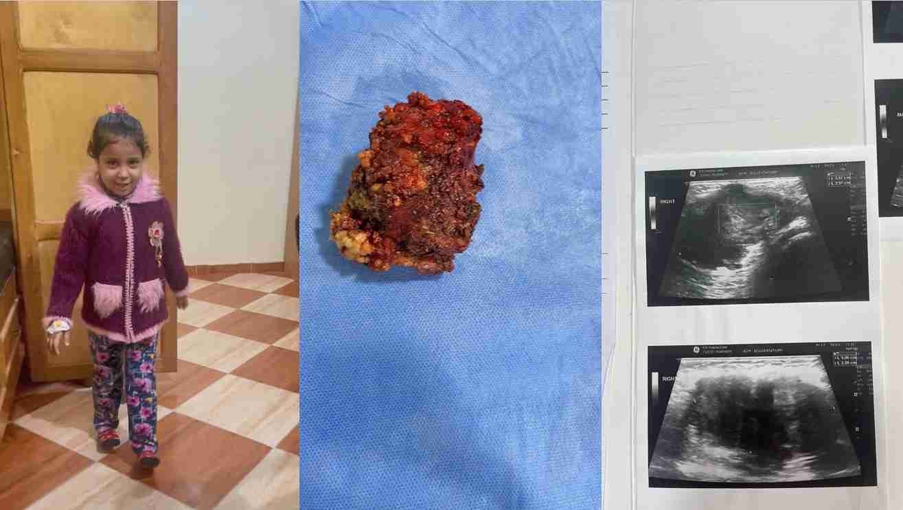 ورم بغلاف عصب عرق النسا الايمن بطفلة خمس سنوات ونصف