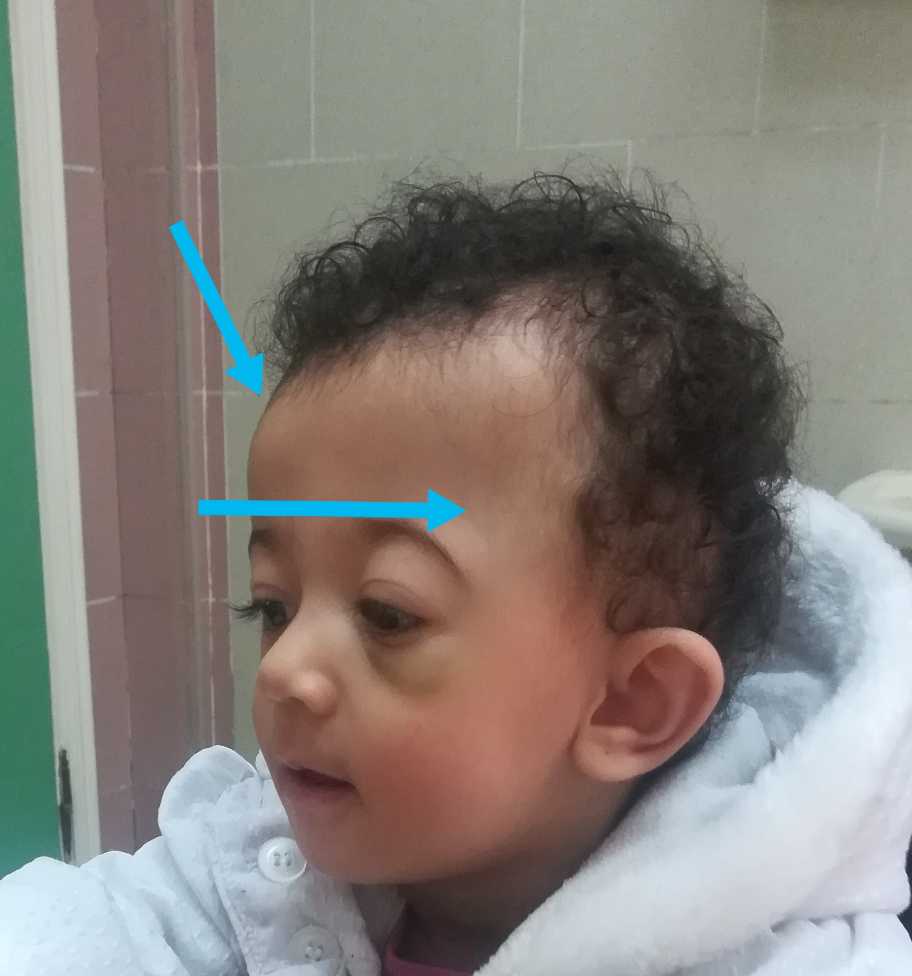 قطع بالعصب الشظوي الايمن