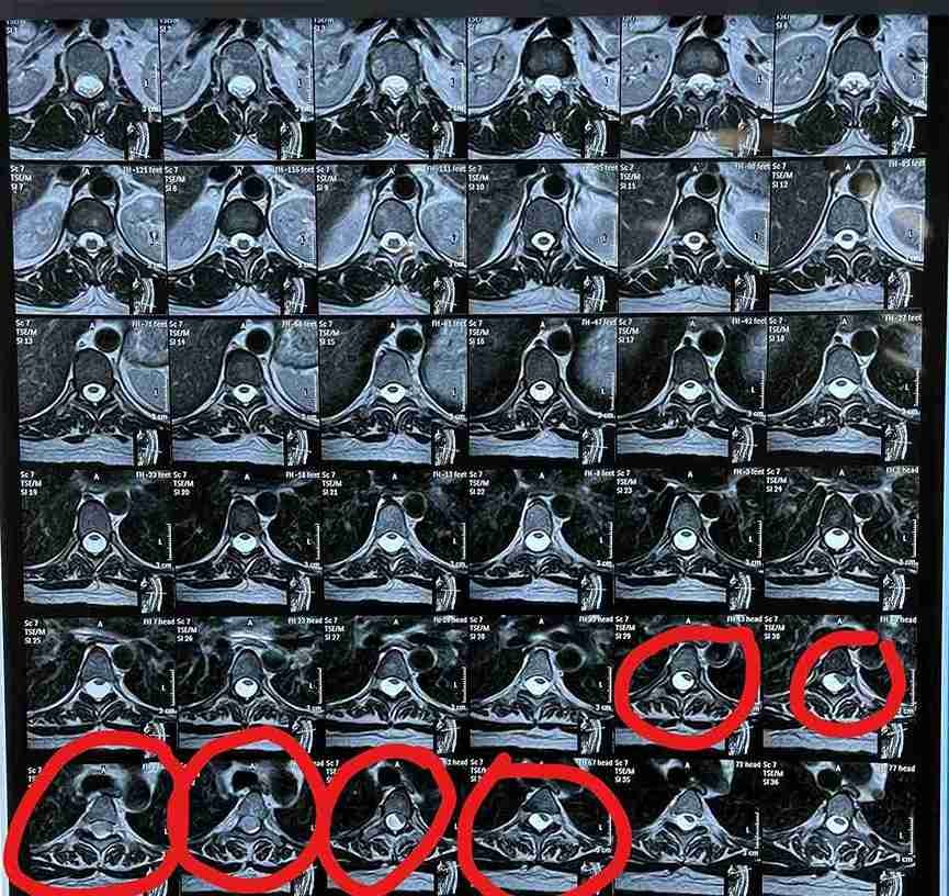 ورم سحائي بالنخاع الشوكي مقابل الفقرة الصدرية الرابعة